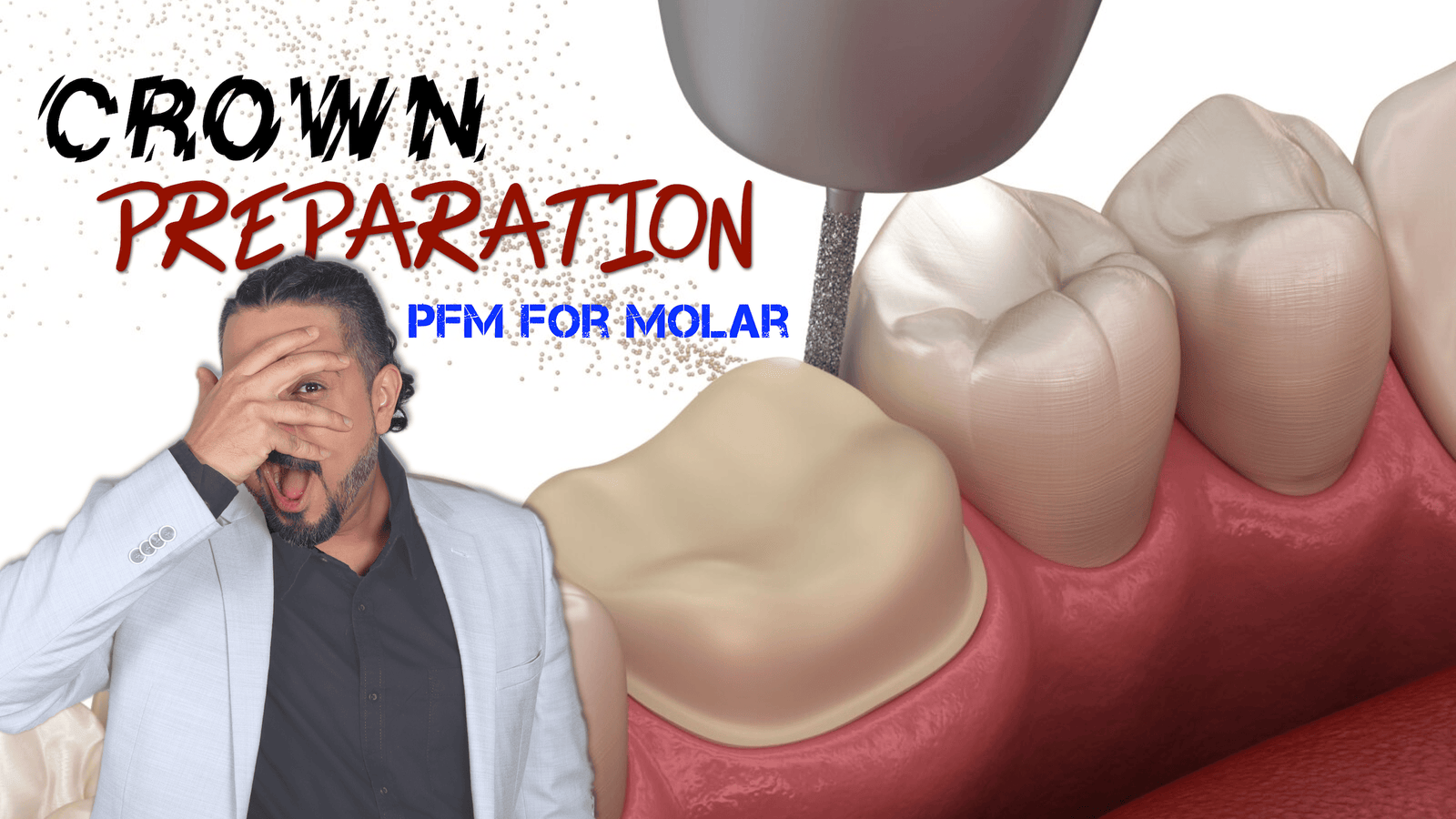 PFM Crown Preparation for Molar (Beginners Course)